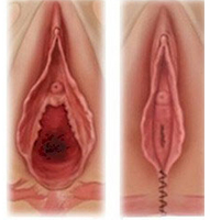 Vaginoplasty-Result-Tunisia